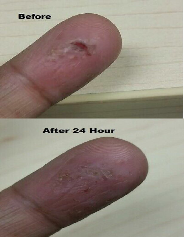 Intense Treatment Cream for Eczema Psoriasis Rosacea Dermatitis Eczemaout Acne