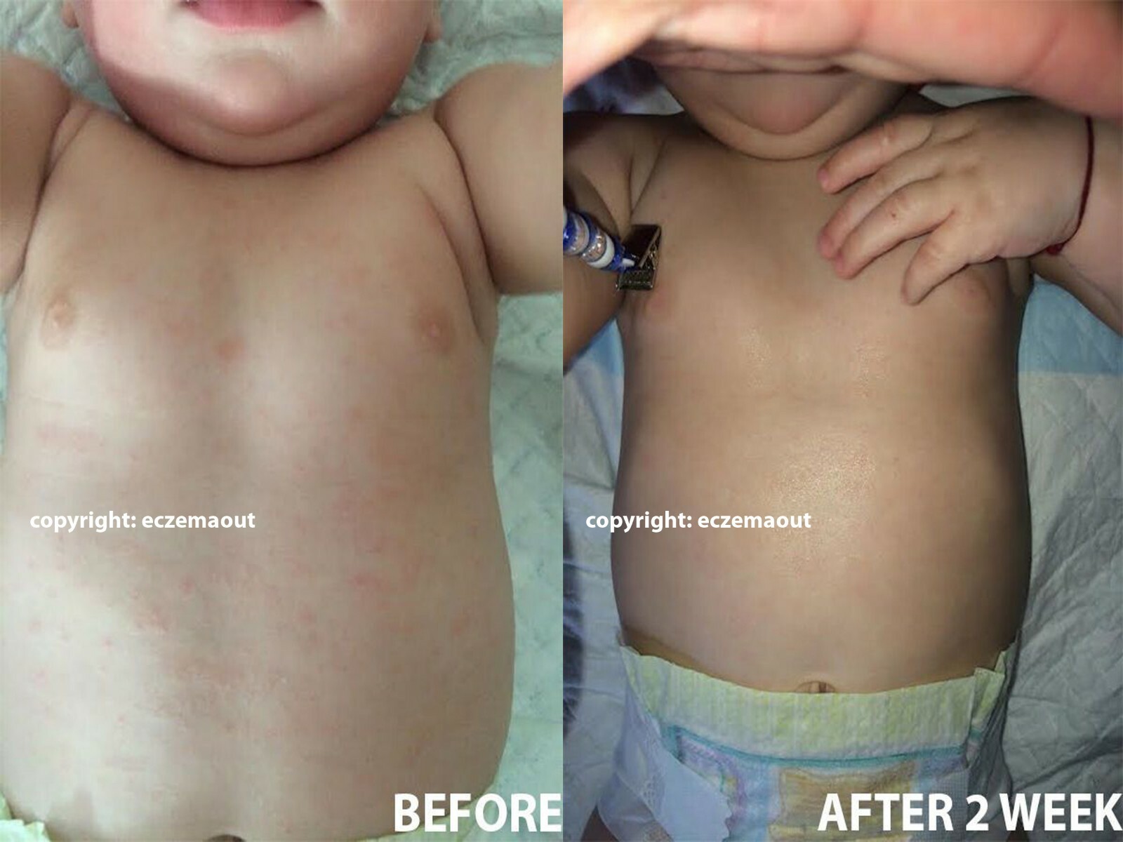 Intense Treatment Cream for Eczema Psoriasis Rosacea Dermatitis Eczemaout Acne