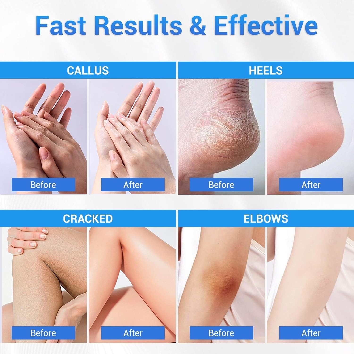 Urea Cream 40 Percent for Feet Maximum Strength, Foot Cream for Dry Cracked Heel
