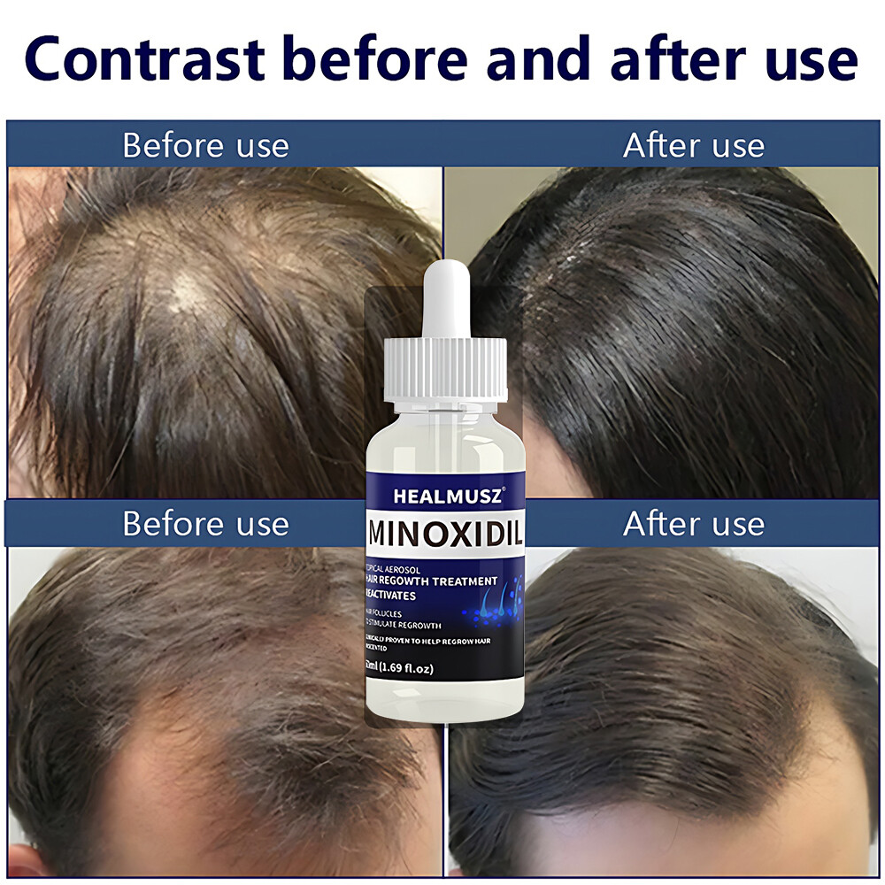 6 Pack Minoxidil 5% Extra Strength Men Hair Regrowth Treatment 6 Month Supply