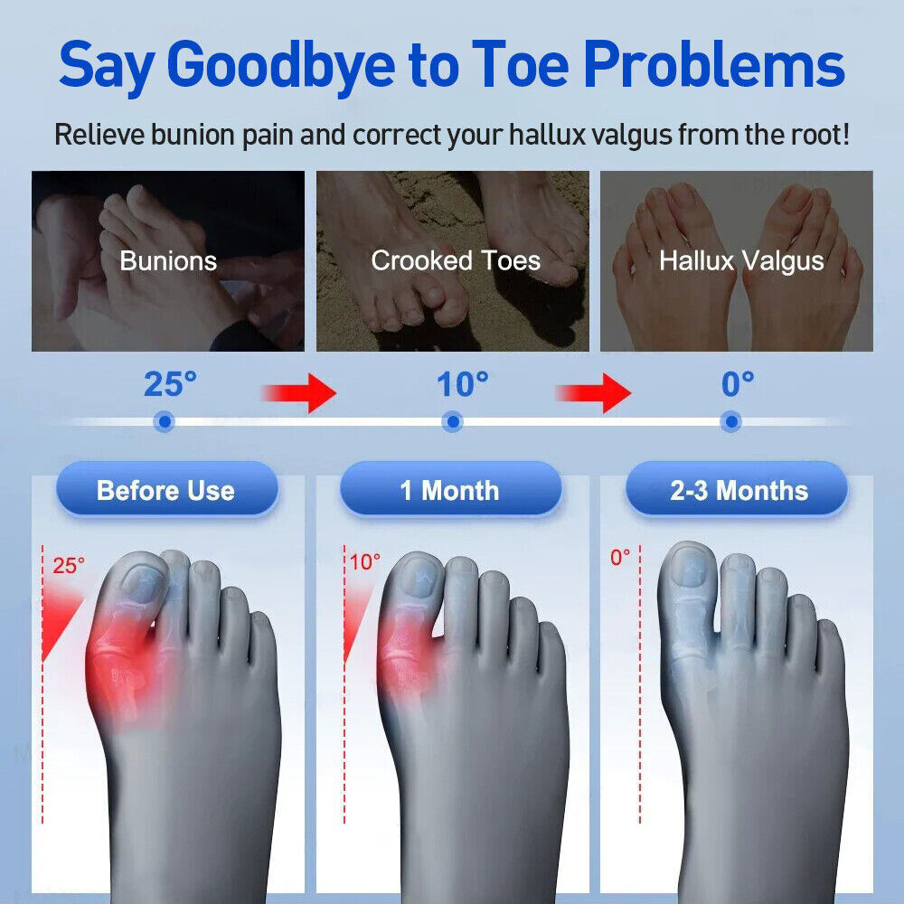 2PCS Bunion Fix Toe Valgus Corrector Big Toe Straightener for Men & Women 1Pair