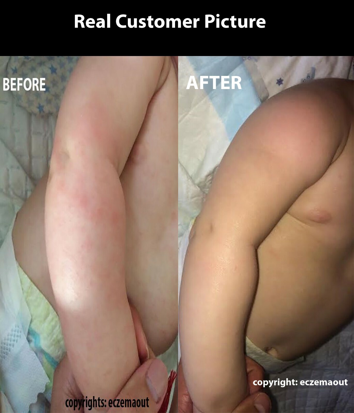 Intense Treatment Cream for Eczema Psoriasis Rosacea Dermatitis Eczemaout Acne