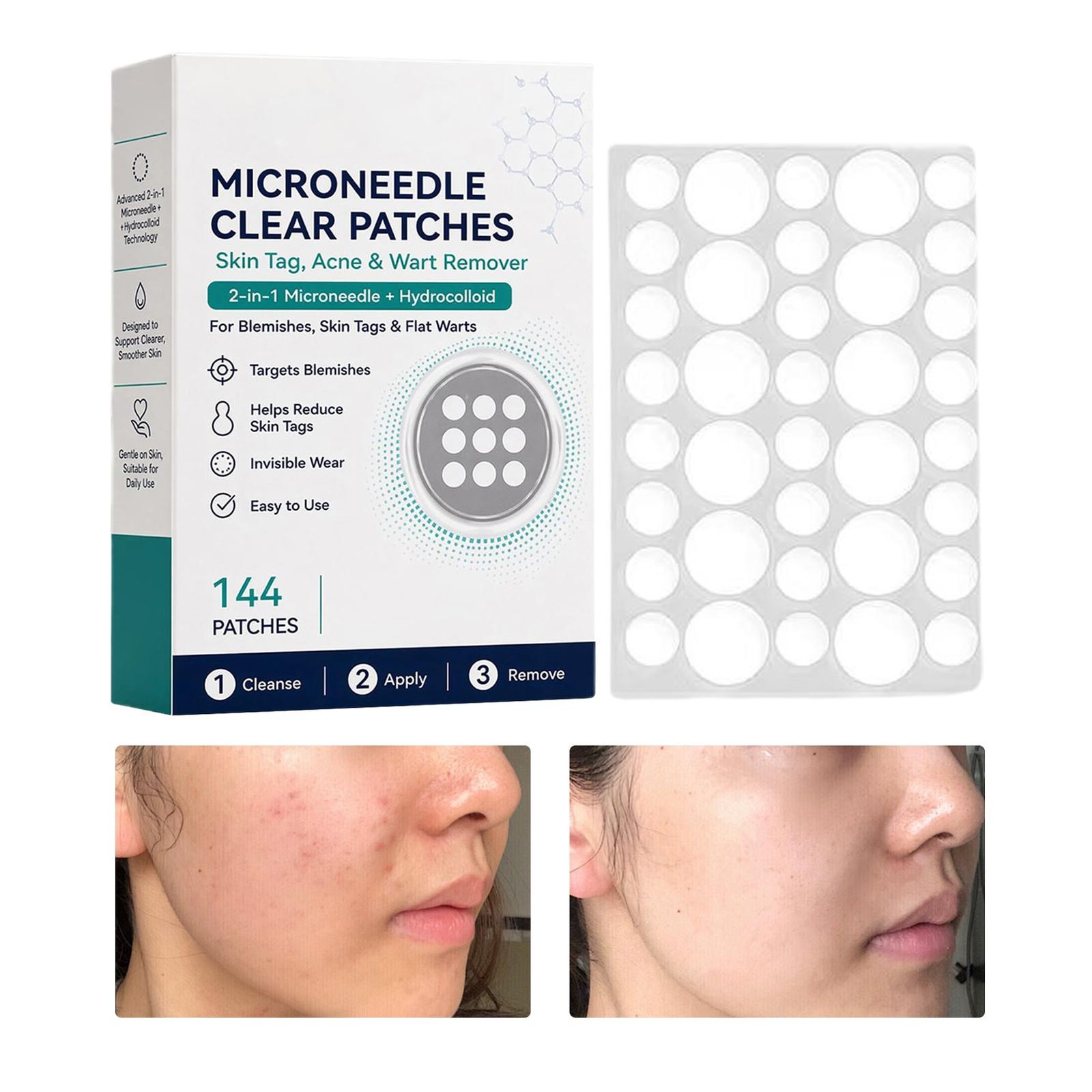 Curalona Microneedle Clear Patches, 2-in-1 Microneedle &Hydrocolloid Patch