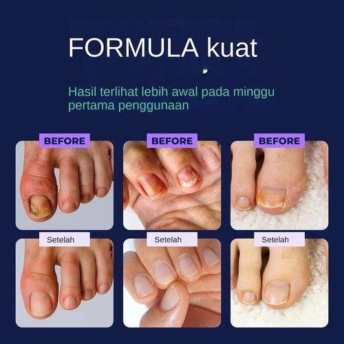 Orivelle Anti Pen, Clear Anti Fungal Pen, Anti Fungal Nail 3ml