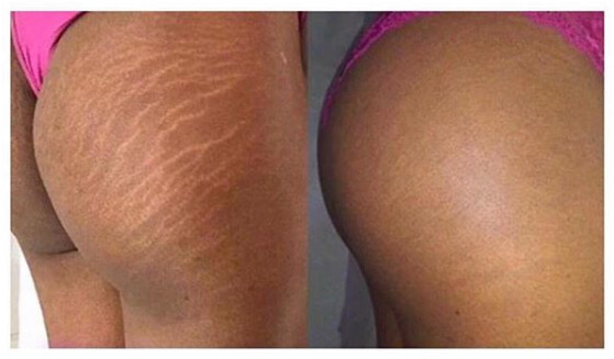 Anti-Cellulite Massage Oil-Tones & Slims Skin & Breaks Down Fat Tissue (60ml)