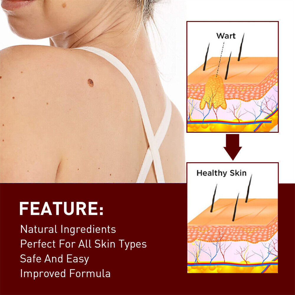 “FINAL SAL” Skin Tags & Moles Removal Quick Safe Remover Restore Skin 3ml US