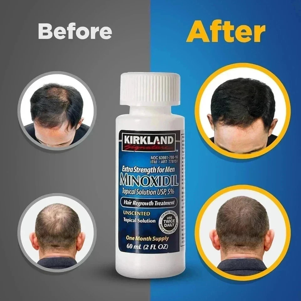 Minoxidil 5% Extra Strength Hair Regrowth Treatment for Men 6-Month Supply